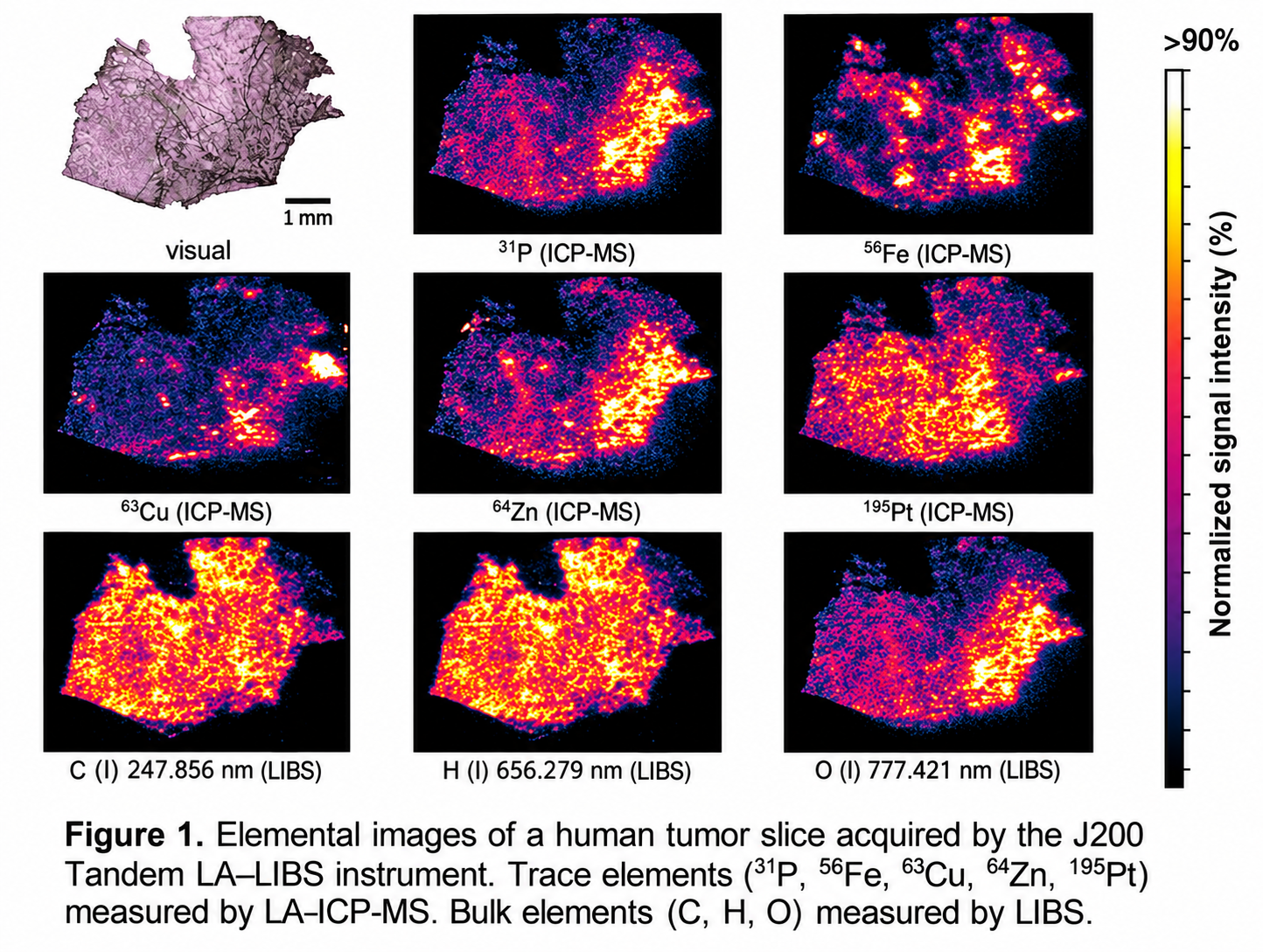 LA-ICP-MS and LIBS elemental images of a human tumor slice for P, Fe, Cu, Zn, Pt, C, H, and O acquired with the J200 Tandem LA–LIBS