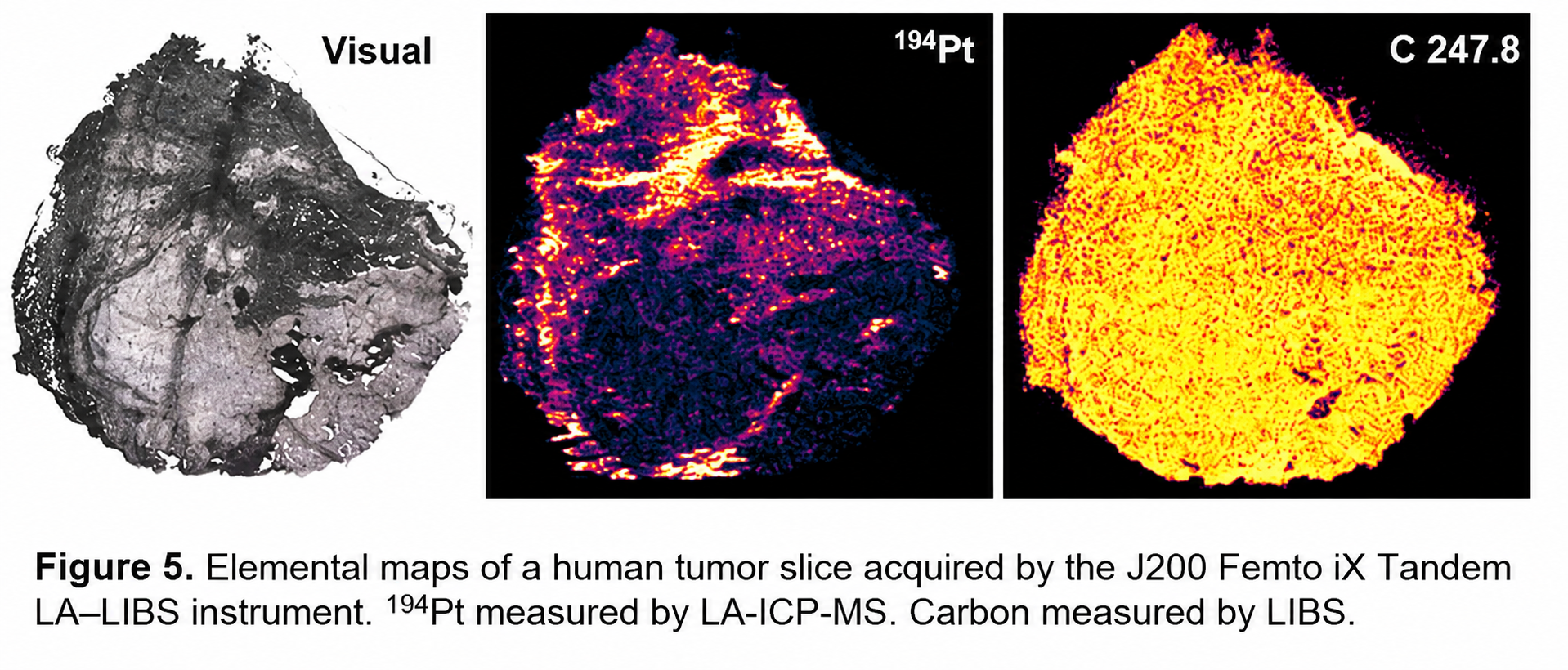 J200 Femto iX Tandem LA–LIBS elemental maps of a human tumor slice showing platinum-194 by LA-ICP-MS and carbon by LIBS